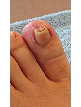 フットケアサロン ラビフット(Rabbi foot)/爪がめっちゃ食い込んでいる！