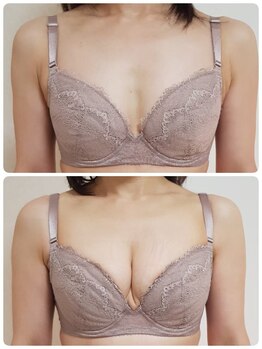 美人バスト リグラス(ReGrous)/バストアップbefore,after