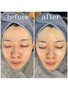 サロンピュア 所沢店/光フェイシャルモニター様♪