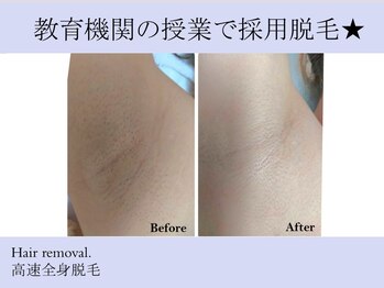 キレイラボ(Ki-Re-i LABO)/圧倒的に抜け早い効果★脱毛施術