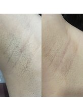 ウルル(ULuLu)/ワキ3回目のビフォーアフター