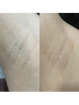 ウルル(ULuLu)/ワキ3回目のビフォーアフター