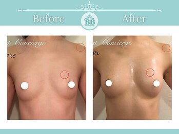 美人バスト 表参道店/【バストアップ/育乳 症例】