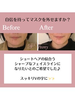 ピオニー(Peony)/Before & After