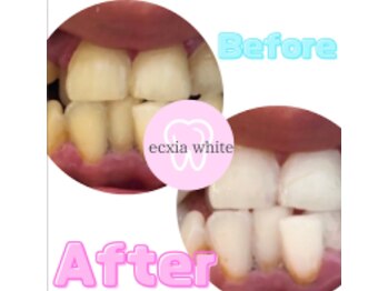 エクシアホワイトニング 可児店/ビフォーアフター