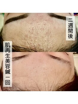 ウル(ulu)/ポツポツニキビには再生美容鍼