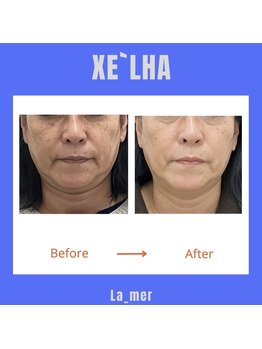 ラメール(La_mer)/【ララピール＋セラピール】10回