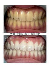 ホワイトニングショップ 長野店/10回終了時