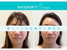 マキシフォート 名駅店(Maxifort)/週1 / 1ヶ月後の小顔変化