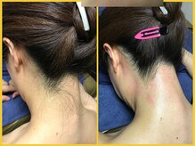 クラウン ジュエルズ(CROWN JEWELS)/【Wax脱毛】うなじ　サイド 6