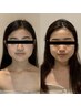 【初回限定】小顔＆毛穴ケア×艶肌体験コース★生ピーリング付き