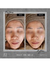 ゴーマルイチ(501)/プラズマシャワー　Before/After