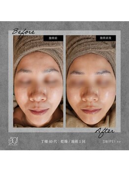 ゴーマルイチ(501)/プラズマシャワー Before/After