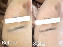 ディアーム 光明池店(Diarm)/ハーブピーリング8回の変化☆