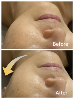 サロンモリ(Mori)/リフトアップ&保湿&美肌