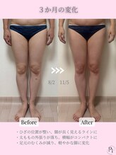 プラスワンビューティテン 新大阪店(Plus One Beauty)/ボディ/ハイパーナイフ/痩身