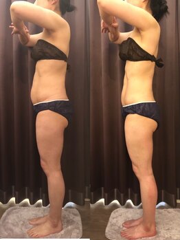 ビーシェイプ 君津(B-Shape)/【痩身】ビフォーアフター