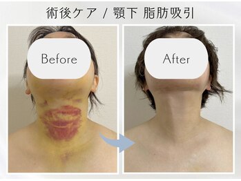 アピ(api)の写真/術後ケア★【フェイシャルインディバ60分￥11,000→￥7,000】吸引/切開リフト/輪郭/シリコン/二重/鼻対応