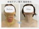 アピ(api)の写真/術後ケア★【フェイシャルインディバ60分￥11,000→￥7,000】吸引/切開リフト/輪郭/シリコン/二重/鼻対応