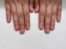 その７☆　深爪・噛み爪などのコンプレックス解消メニューでお悩み改善