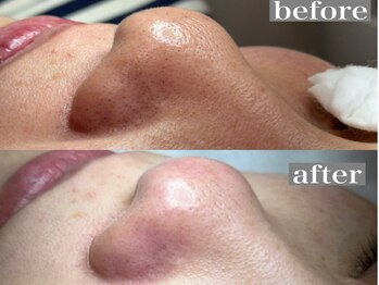 ライカブルー(RaicA BluE)/施術写真　before-after