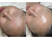プルスキンサロン 大阪店(pull skin salon)の雰囲気（赤み/敏感肌/アクネ/肌トラブルケア全てpullへお任せください♪）