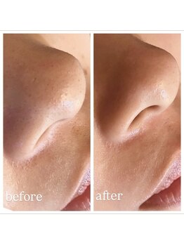 リエイト(Re:eight)/ハイドラ毛穴洗浄