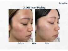 リベルテ(Liberte)/10代後半｜施術6回目B/A