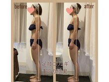 レアフィート(Rheafeet)/症例写真です。