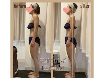 レアフィート(Rheafeet)/症例写真です。