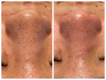 リジュベネ(rejuvena)/ハイドラ洗浄＋ハーブピーリング