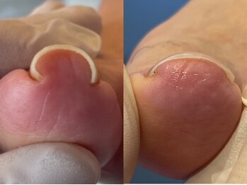 地爪ケアクリニックサロン 代々木店の写真/巻き爪にお悩みの方必見!自分ではなかなか難しい巻き爪ケアはプロにお任せください!