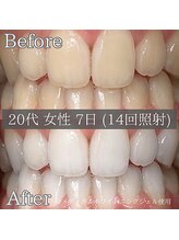 シカホワイトニングトウキョウ 笹塚店(CICA Whitening Tokyo)/ビフォーアフター（20代女性）