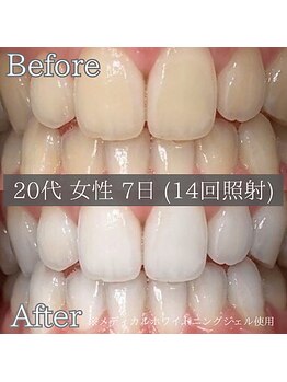 シカホワイトニングトウキョウ 笹塚店(CICA Whitening Tokyo)/ビフォーアフター(20代女性)