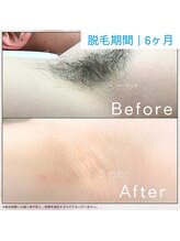 メンズクリア つくば店/【メンズクリア】お客様の施術例