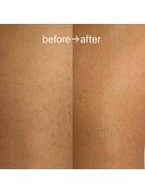 スリーズララ(Cerise LaLa)/すね脱毛のbefore→after