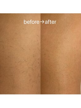 スリーズララ(Cerise LaLa)/すね脱毛のbefore→after