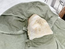 ヒール(heal)/ハーブピーリング