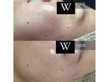 ダブル(W)/陶肌トリートメント