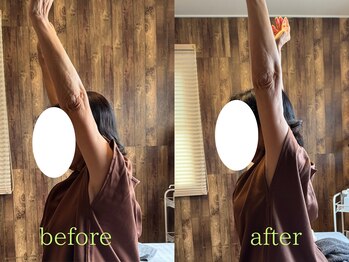 アポヨ鍼灸院(APOYO鍼灸院)/鍼整体　before/after