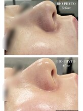 ミベル(MeBell)/剥離なしハーブピーリング