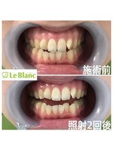 ルブラン 奈良店(Le Blanc)/25回数券で確実に白く！