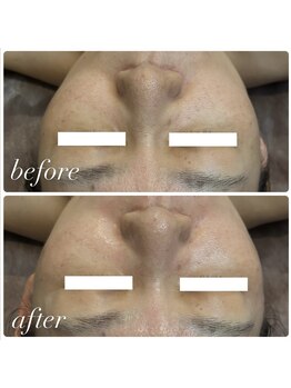 ビアス(Biasu)/バクチオールピール1回での効果