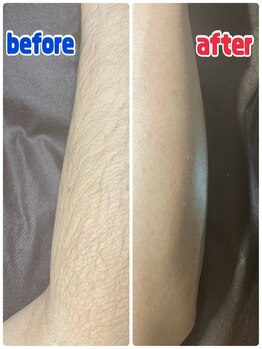 エステサロン桜/ひじ下ワックス脱毛