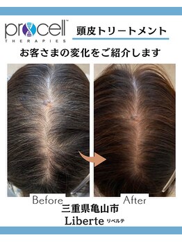 リベルテ(Liberte)/プロセル頭皮トリートメント