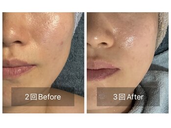 ランファビューティー(蘭花Beauty)の写真/モニター募集【艶玉肌♪肌育ペプチド×ラミネーションピーリング90
分】シミ・たるみ改善★敏感肌OK 