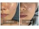 ランファビューティー(蘭花Beauty)の写真/モニター募集【艶玉肌♪肌育ペプチド×ラミネーションピーリング90
分】シミ・たるみ改善★敏感肌OK 