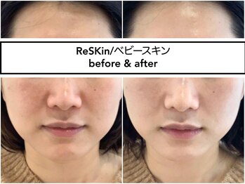 ディアメ(Diame)/モヤっと感も一度でこの通り♪