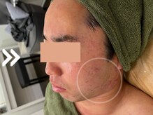 グリーンピール エルモナ(GREENPEEL ELMONA)/【グリーンピール５Days】