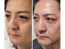 メンズ ユシュレ(Men's YUSYURE)の雰囲気（ニキビケア,エイジングケア等お肌の悩みにOHLハーブピーリング♪）